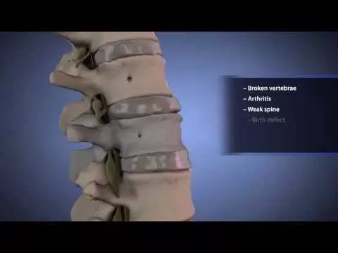 posterior non-segmental instrumentation | Spinal Instrumentation