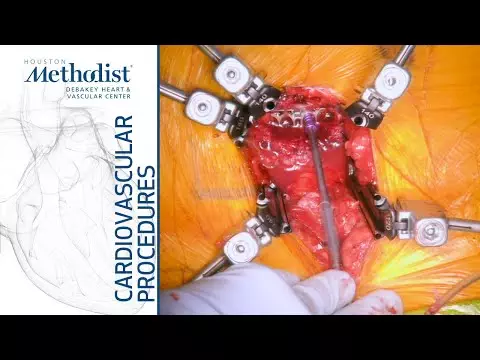 spinal instrumentation surgical techniques | Anterior Lumbar Interbody Fusion - ALIF (Meng Huang, MD, Linda Le, MD, Philip Auyang, MD)